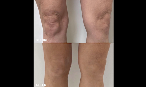 Plasma IQ Wrinkle Treatment Before After Mississauga Oakvill